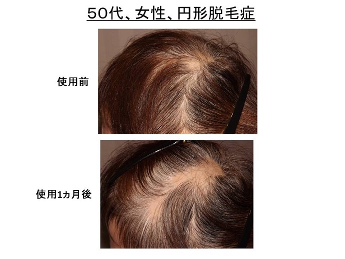 円形脱毛症　病院""
